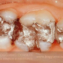 Amalgama dentale