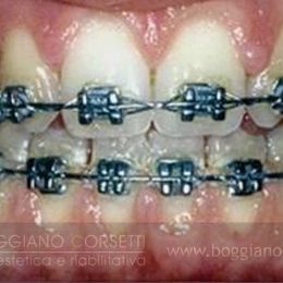 Apparecchio dentale