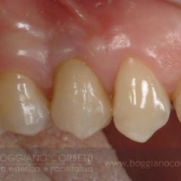 Denti e gengive