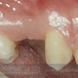 Denti e gengive