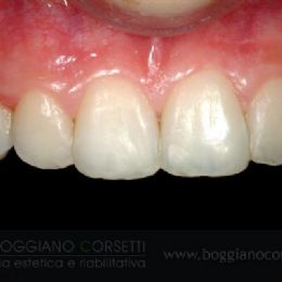 Denti fratturati per abitudini viziate (mordicchiamento della penna) - DOPO