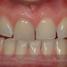 faccette per denti che presentano diastemi