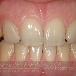 faccette per denti con anomalie di forma