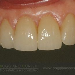faccette per denti con difetti dello smalto
