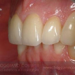 Faccette per ortodonzia istantanea 4