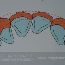 Faccette per ortodonzia istantanea