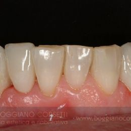 Faccette per ortodonzia istantanea 6