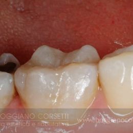 Intarsi dentale in ceramica