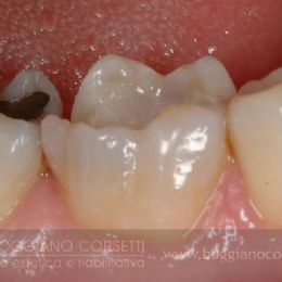 Intarsi dentale in ceramica