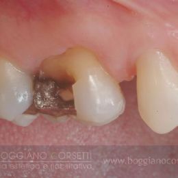 Intarsi dentale in ceramica