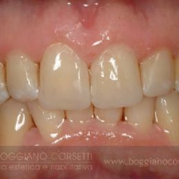 Restauro in composito di denti con abrasione da spazzolamento - DOPO