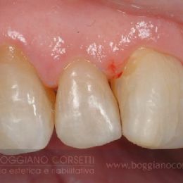 Ricostruzione delle superfici occlusali abrase da digrignamento (bruxismo) - DOPO