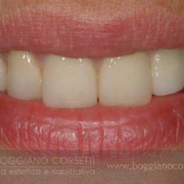 Smile Make Over