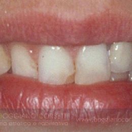 Smile Make Over