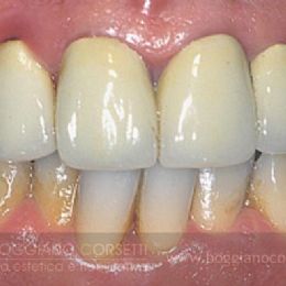 Sostituzione corone dentali con bordo metallico