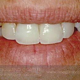 Sostituzione corone dentali con bordo metallico