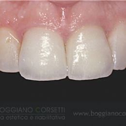 Sostituzione corone dentali con bordo metallico
