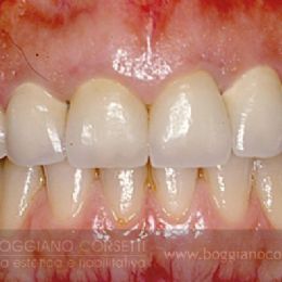 Sostituzione corone dentali con bordo metallico