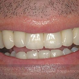Sostituzione corone dentali con bordo metallico