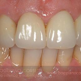 Sostituzione corone dentali con bordo metallico