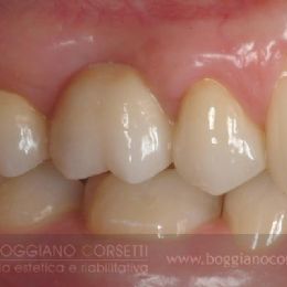 Sostituzione corone dentali con bordo metallico